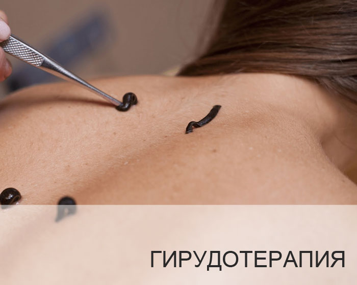 Гирудотерапия. Лечение пиявками в Иркутск